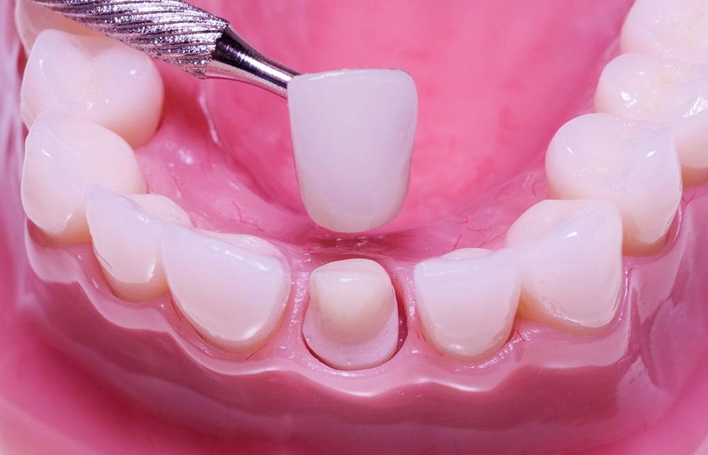 Bọc răng sứ: Để có hàm răng đẹp hoàn hảo, chúng ta phải bỏ ra bao nhiêu tiền?